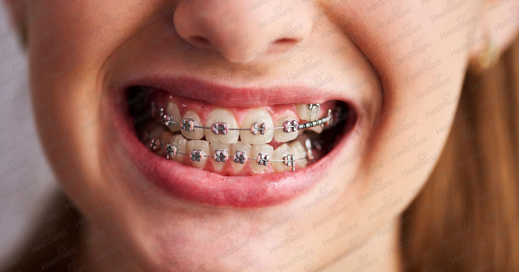 How To Care For Your Teeth When You Have Braces - Healthians Blog